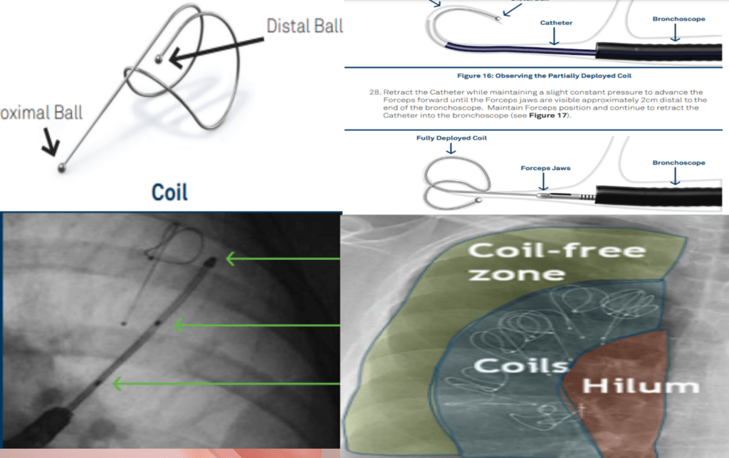 coil uygulanması koah