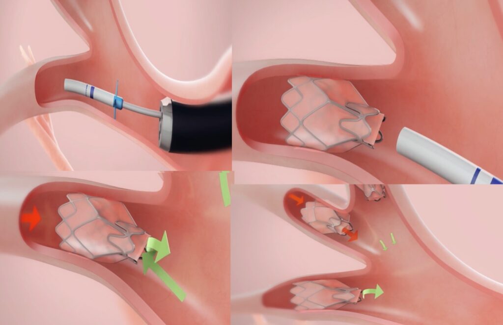 endobronşial valfin görünümü